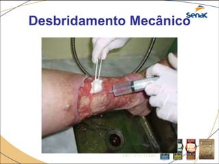 Desbridamento Mecânico
 