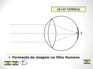 OLHO NORMAL
 Formação da imagem no Olho Humano
I
(C
)
 