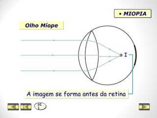 Olho Míope
• MIOPIA
I
A imagem se forma antes da retina
(C
)
 