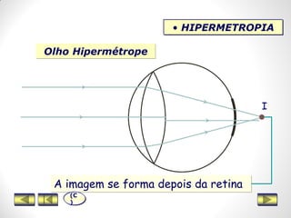 Olho Hipermétrope
• HIPERMETROPIA
I
A imagem se forma depois da retina
(C
)
 