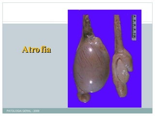 Atrofia PATOLOGIA GERAL - 2009 