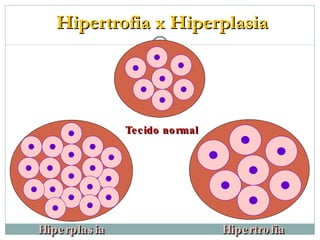 Hipertrofia x Hiperplasia Tecido normal Hipertrofia Hiperplasia 