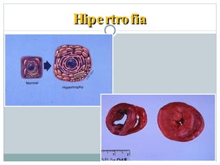 Hipertrofia Pato Geral - 2004/2 