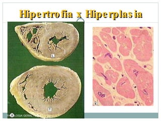 Hipertrofia x Hiperplasia PATOLOGIA GERAL - 2009 