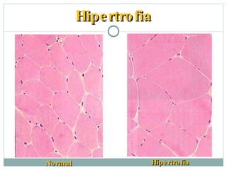 Hipertrofia Normal Hipertrofia 