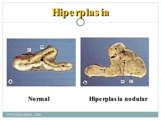Hiperplasia Normal Hiperplasia nodular PATOLOGIA GERAL - 2009 