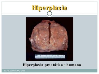 Hiperplasia Hiperplasia prostática - humano PATOLOGIA GERAL - 2009 