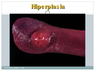 Hiperplasia PATOLOGIA GERAL - 2009 