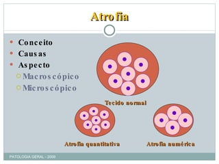 Atrofia Conceito Causas Aspecto  Macroscópico Microscópico Tecido normal Atrofia numérica Atrofia quantitativa PATOLOGIA GERAL - 2009 