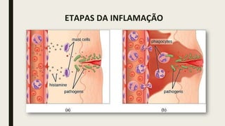 ETAPAS DA INFLAMAÇÃO
 