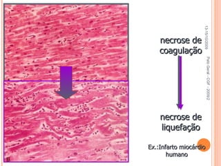 Pato Geral - CGF - 2009/2 Ex.:Infarto miocárdio humano necrose de coagulação 13-15/10/2009 necrose de liquefação 