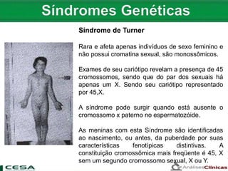 Síndrome de Turner
Rara e afeta apenas indivíduos de sexo feminino e
não possui cromatina sexual, são monossômicos.
Exames de seu cariótipo revelam a presença de 45
cromossomos, sendo que do par dos sexuais há
apenas um X. Sendo seu cariótipo representado
por 45,X.
A síndrome pode surgir quando está ausente o
cromossomo x paterno no espermatozóide.
As meninas com esta Síndrome são identificadas
ao nascimento, ou antes, da puberdade por suas
características fenotípicas distintivas. A
constituição cromossômica mais freqüente é 45, X
sem um segundo cromossomo sexual, X ou Y.
 