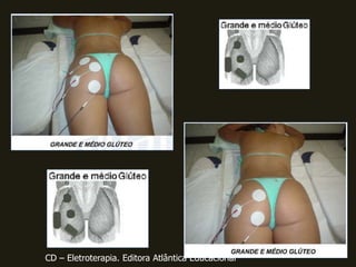 CD – Eletroterapia. Editora Atlântica Educacional
 