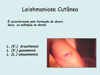 Leishmaniose Cutânea
É caracterizada pela formação de úlcera
única ou múltiplas na derme
L. (V.) braziliensis
L. (V.) guyanensis
L. (L.) amazonensis
 