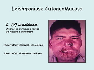Leishmaniose CutaneoMucosa
L. (V) braziliensis
Úlceras na derme,com lesões
de mucosa e cartilagem
Reservatório Urbano=> cão,eqüino
Reservatório silvestre=> roedores
 