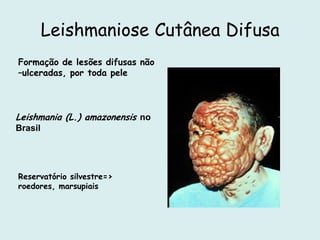 Leishmaniose Cutânea Difusa
Formação de lesões difusas não
–ulceradas, por toda pele
Leishmania (L.) amazonensis no
Brasil
Reservatório silvestre=>
roedores, marsupiais
 