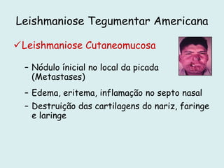 Leishmaniose Tegumentar Americana
Leishmaniose Cutaneomucosa
– Nódulo ínicial no local da picada
(Metastases)
– Edema, eritema, inflamação no septo nasal
– Destruição das cartilagens do nariz, faringe
e laringe
 