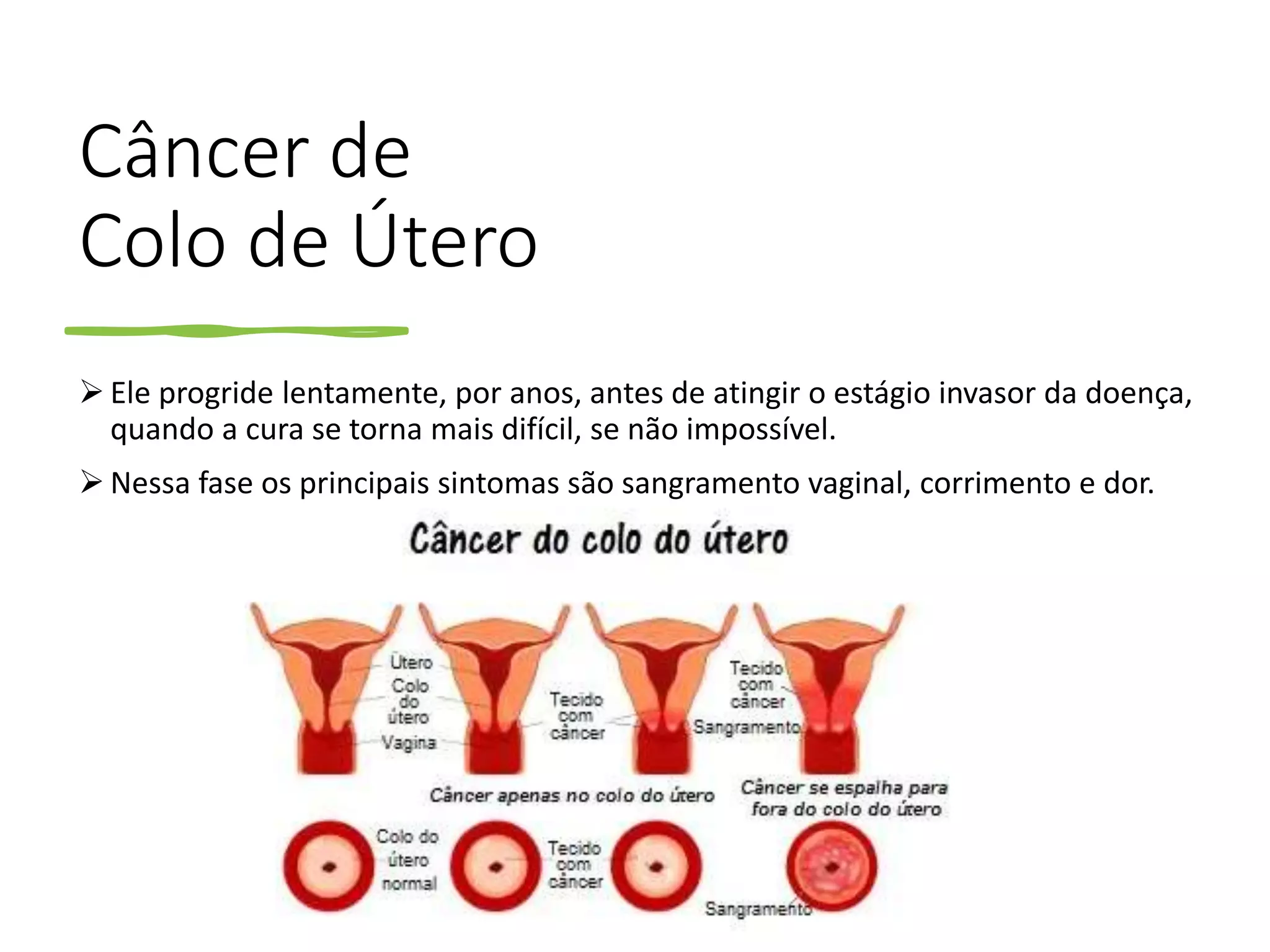 AULA 08 - CÂNCER DE COLO DE ÚTERO E MAMA.pptx