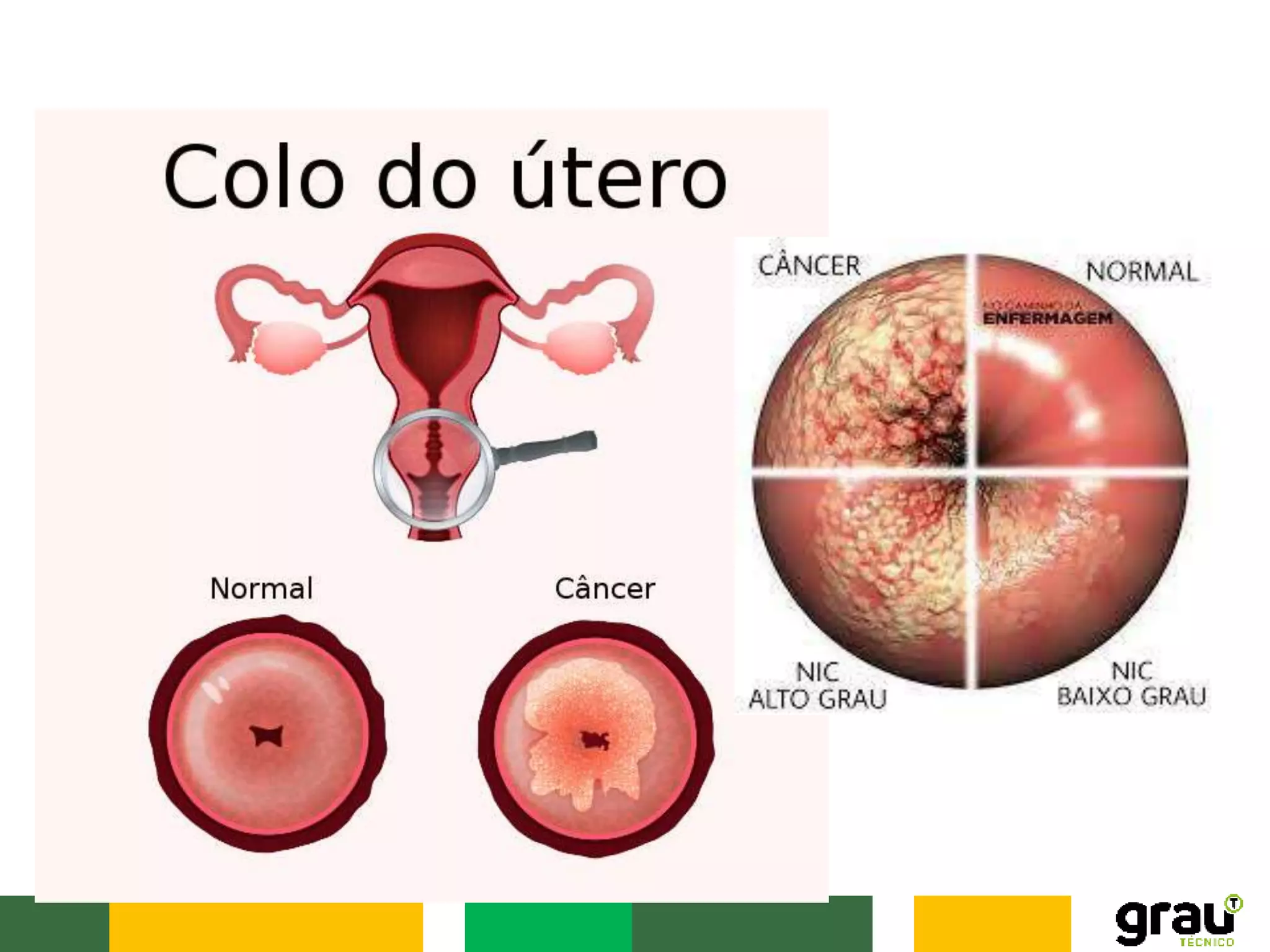 AULA 08 - CÂNCER DE COLO DE ÚTERO E MAMA.pptx