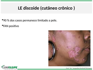 Prof.ª Dr.ª Jacqueline Kerkhoff Richoppo
LE discoide (cutâneo crônico )
90 % dos casos permanece limitado a pele.
FAN positivo
 