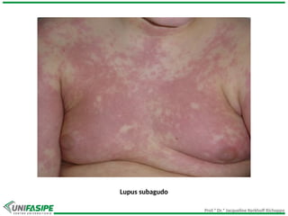 Prof.ª Dr.ª Jacqueline Kerkhoff Richoppo
Lupus subagudo
 