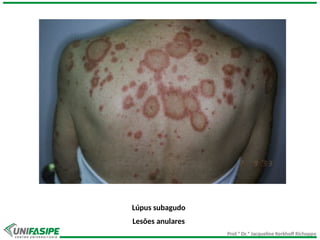 Prof.ª Dr.ª Jacqueline Kerkhoff Richoppo
Lúpus subagudo
Lesões anulares
 