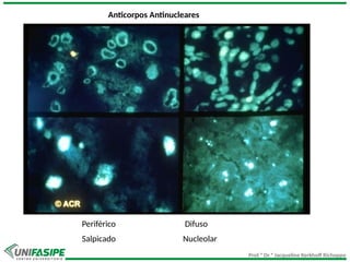 Prof.ª Dr.ª Jacqueline Kerkhoff Richoppo
Periférico Difuso
Salpicado Nucleolar
Anticorpos Antinucleares
 