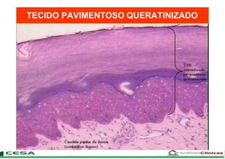 TECIDO PAVIMENTOSO QUERATINIZADO
 