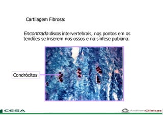 Cartilagem Fibrosa:
Encontrada:discos intervertebrais, nos pontos em os
tendões se inserem nos ossos e na sínfese pubiana.
Condrócitos
 