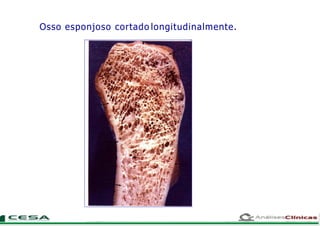 Osso esponjoso cortado longitudinalmente.
 