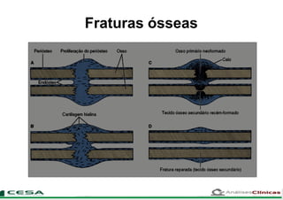 Fraturas ósseas
 