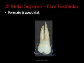 2º Molar Superior – Face Vestibular
• Formato trapezoidal.
Caíque Araujo Siqueira
 