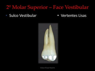 2º Molar Superior – Face Vestibular
• Sulco Vestibular • Vertentes Lisas
Caíque Araujo Siqueira
 
