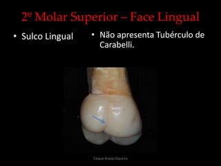 2º Molar Superior – Face Lingual
• Sulco Lingual • Não apresenta Tubérculo de
Carabelli.
Caíque Araujo Siqueira
 