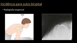 Incidência para sulco bicipital
• Radiografia tangencial
 