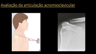 Avaliação da articulação acromioclavicular
 
