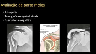 Avaliação de parte moles
• Artrografia
• Tomografia computadorizada
• Ressonância magnética
 