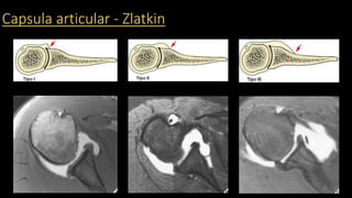 Capsula articular - Zlatkin
 