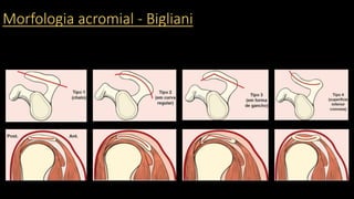 Morfologia acromial - Bigliani
 