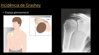 Incidência de Grashey
• Espaço glenoumeral
 