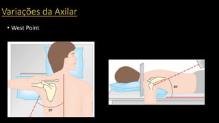 Variações da Axilar
• West Point
 