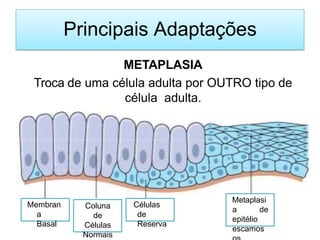 Principais Adaptações
METAPLASIA
Troca de uma célula adulta por OUTRO tipo de
célula adulta.
Membran
a
Basal
Coluna
de
Células
Normais
Células
de
Reserva
Metaplasi
a de
epitélio
escamos
 