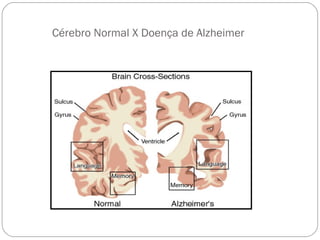 Cérebro Normal X Doença de Alzheimer
 