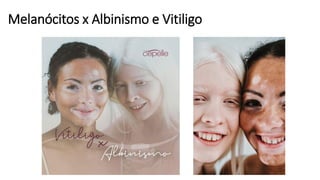 Melanócitos x Albinismo e Vitiligo
 