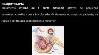 BRAQUITERAPIA
Tratamento interno ou a curta distância através de pequenas
sementesradioativas que são colocadas diretamente no corpo do paciente, na
região à ser tratada ou diretamente no tumor.
 