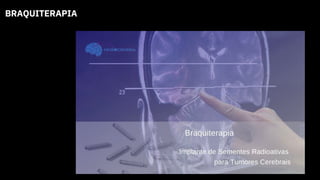 BRAQUITERAPIA
 