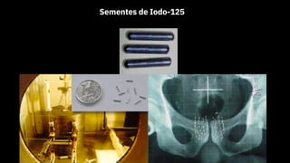Sementes de Iodo-125
 