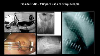 Fios de Irídio - 192 para uso em Braquiterapia
 