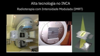 Alta tecnologia no INCA
Radioterapia com Intensidade Modulada (IMRT)
 
