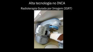 Alta tecnologia no INCA
Radioterapia Guiada por Imagem (IGRT)
 
